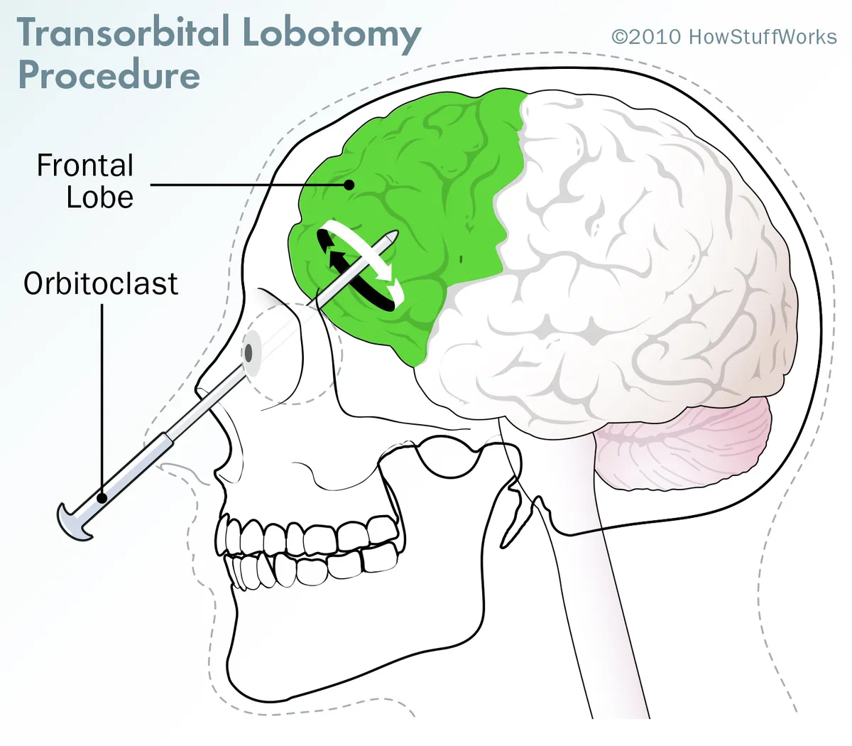 "LOBOTOMY"
