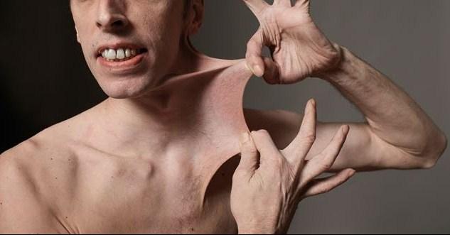 "EHLERS DANLOS SYNDROME"